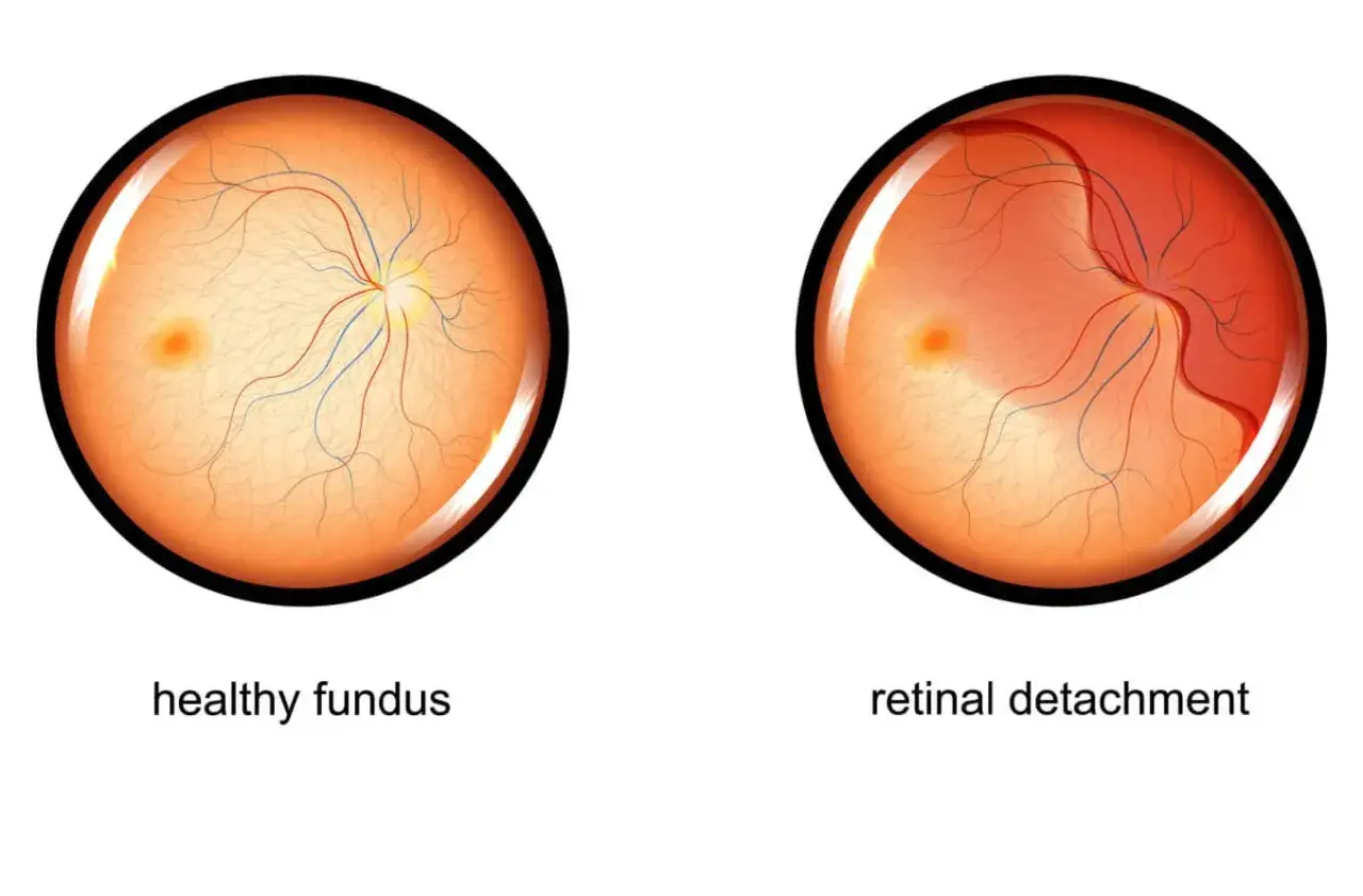 Confronto tra fondo oculare sano e distacco di retina. Il laser può aiutare nella convalescenza dopo un foro retinico.