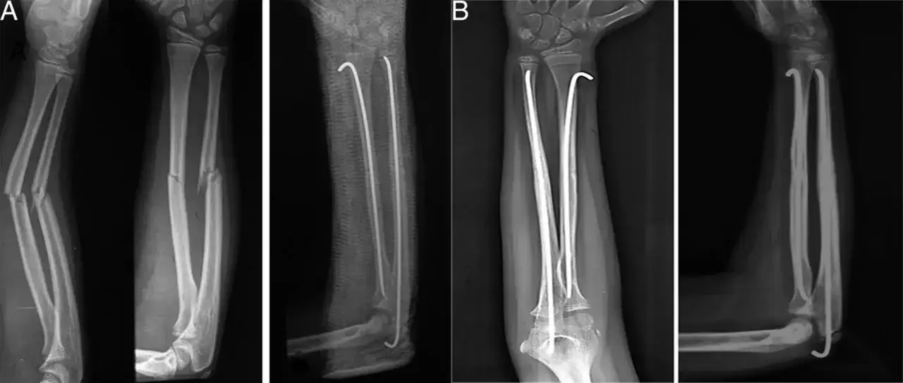 Radiografías de antebrazo mostrando una fractura en tallo verde en ambos huesos, tratada con clavos intramedulares.