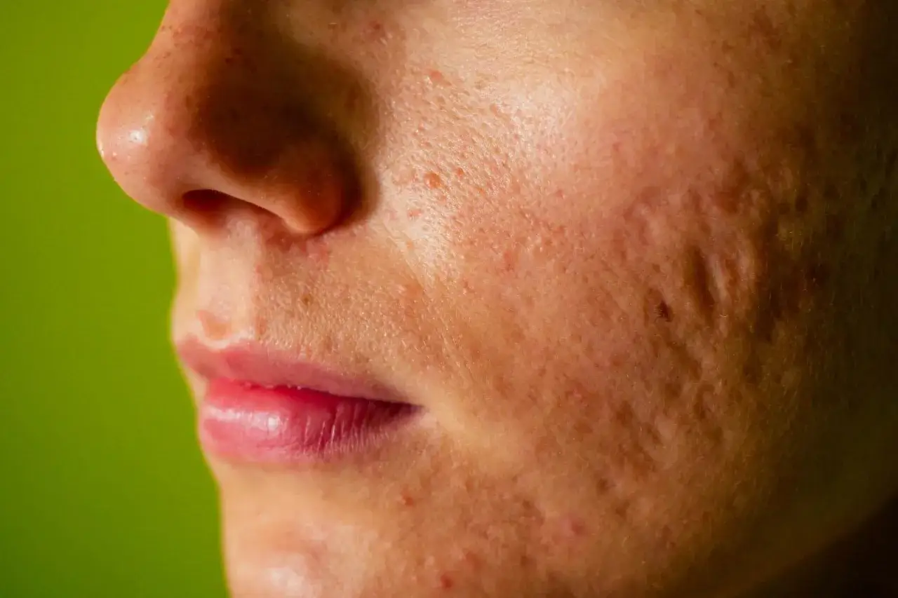skincare routine for red post acne marks