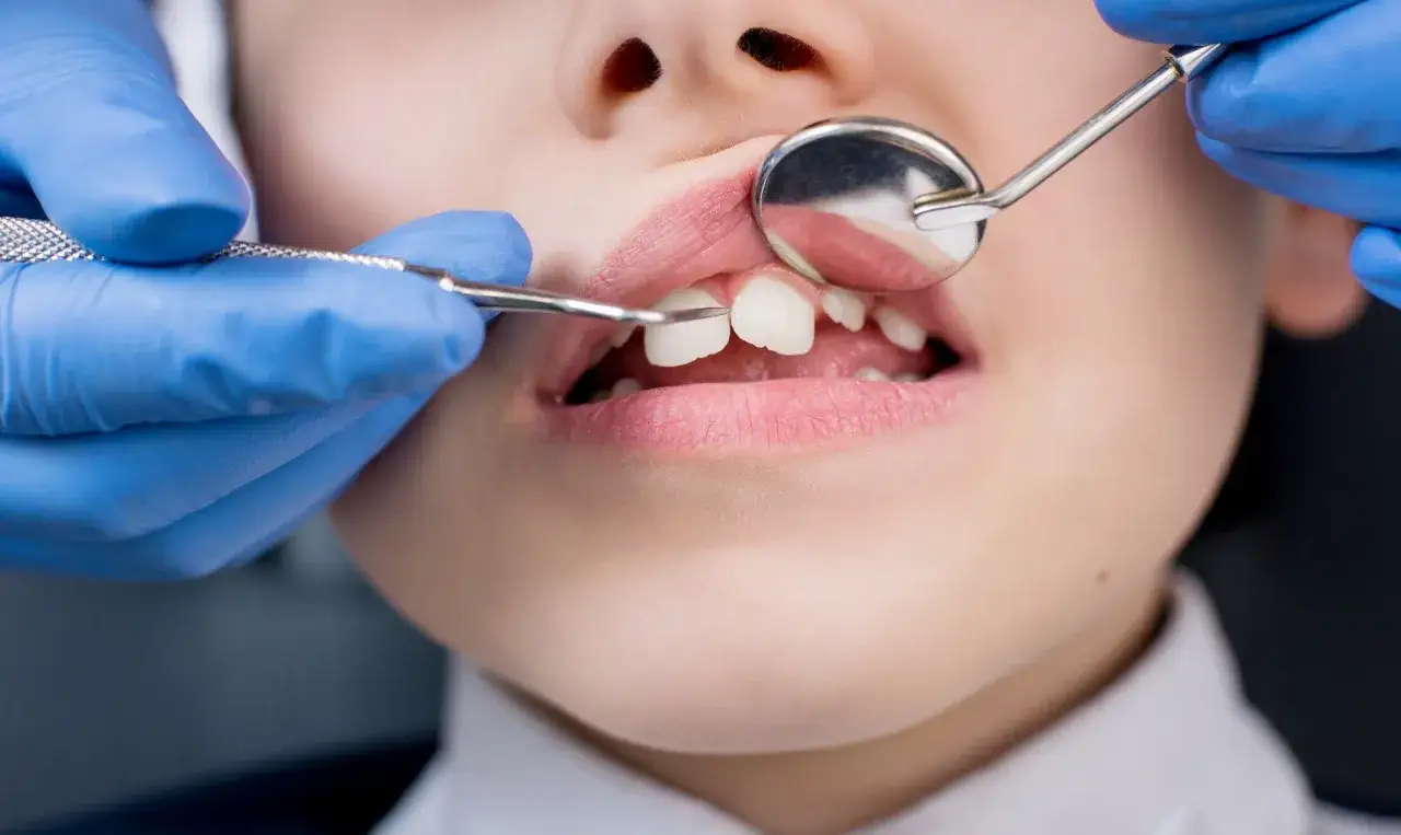 Dziecko u dentysty. Specjalista w niebieskich rękawiczkach bada ząbki za pomocą lusterka i narzędzia.
