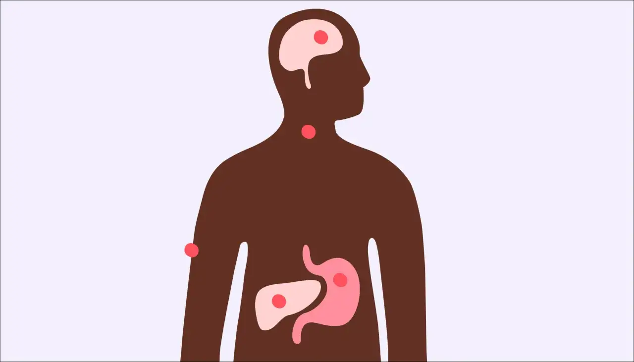 Illustration av en m&auml;nsklig silhuett med markerade organ som hj&auml;rna, hals, mage och lever. R&ouml;da prickar indikerar potentiella problemomr&aring;den kopplade till stressrelaterade sjukdomar.