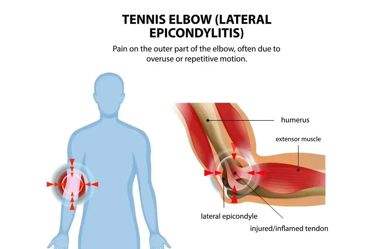 Dolore al gomito del tennista, con infiammazione del tendine sull'epicondilo laterale.