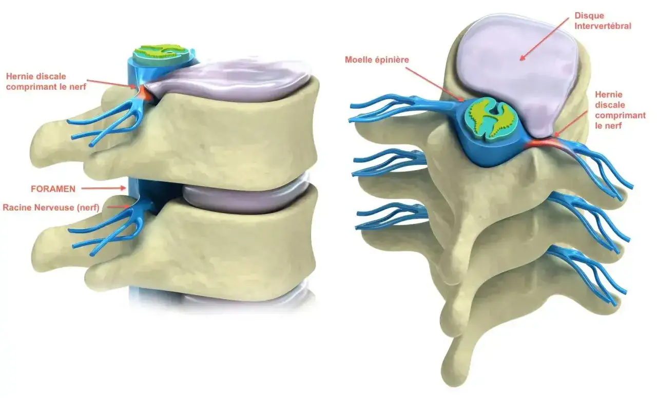 Illustration d'une discopathie L5 S1 montrant une hernie discale comprimant une racine nerveuse.