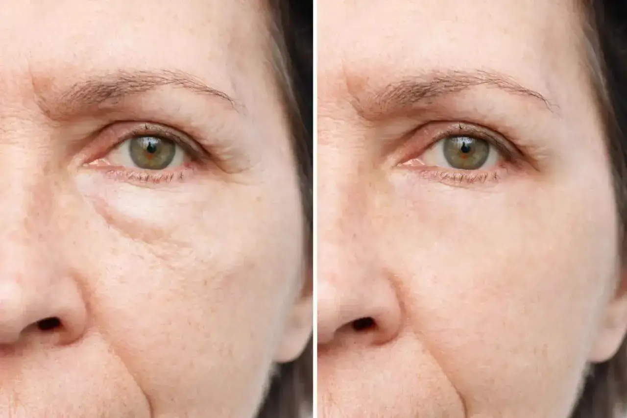 Före och efter bilder visar en kvinna som njuter av solen efter botox. Rynkor runt ögonen har minskat.