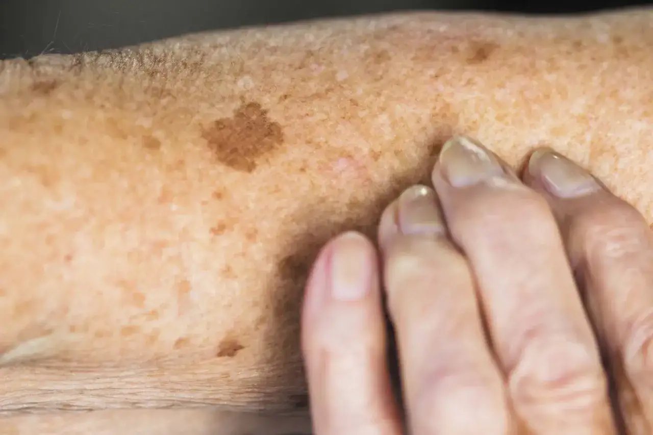 Close-up of an arm showing sunspots and age spots, common signs you are aging poorly. Fingers are visible on the right.
