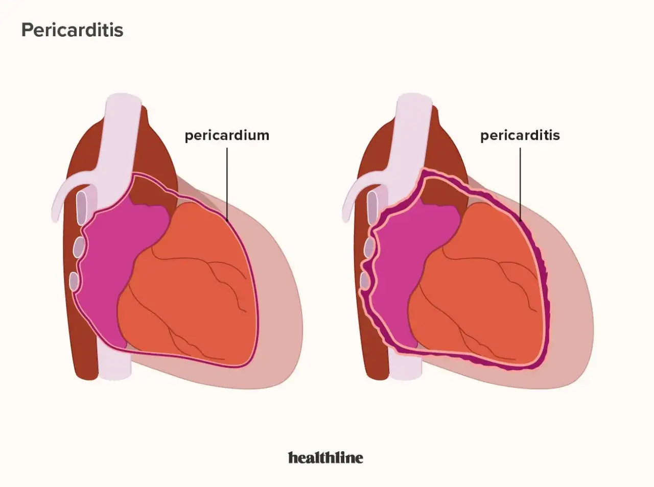 Confronto tra pericardio sano e pericardite. L'ansia può contribuire a questa infiammazione cardiaca.