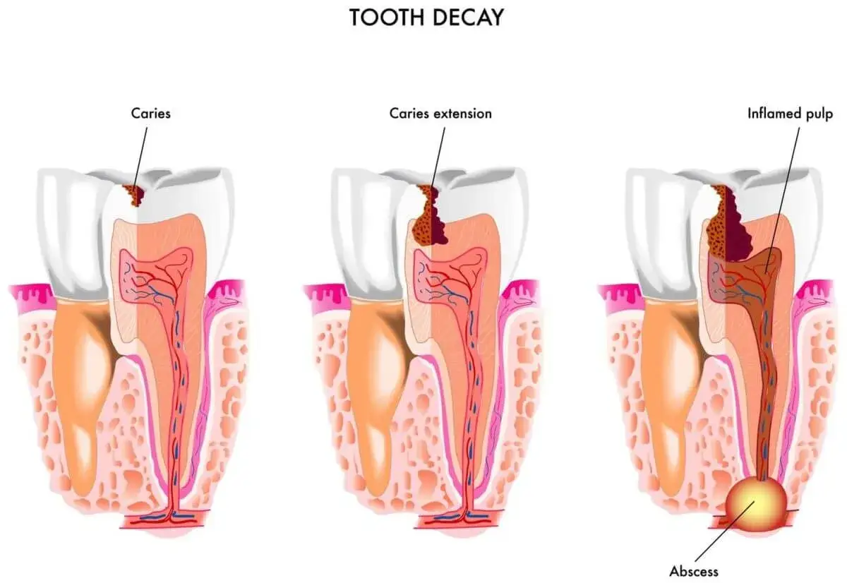 Illustrazione mostra la carie che avanza nel dente, raggiungendo il nervo e causando infiammazione e ascesso.