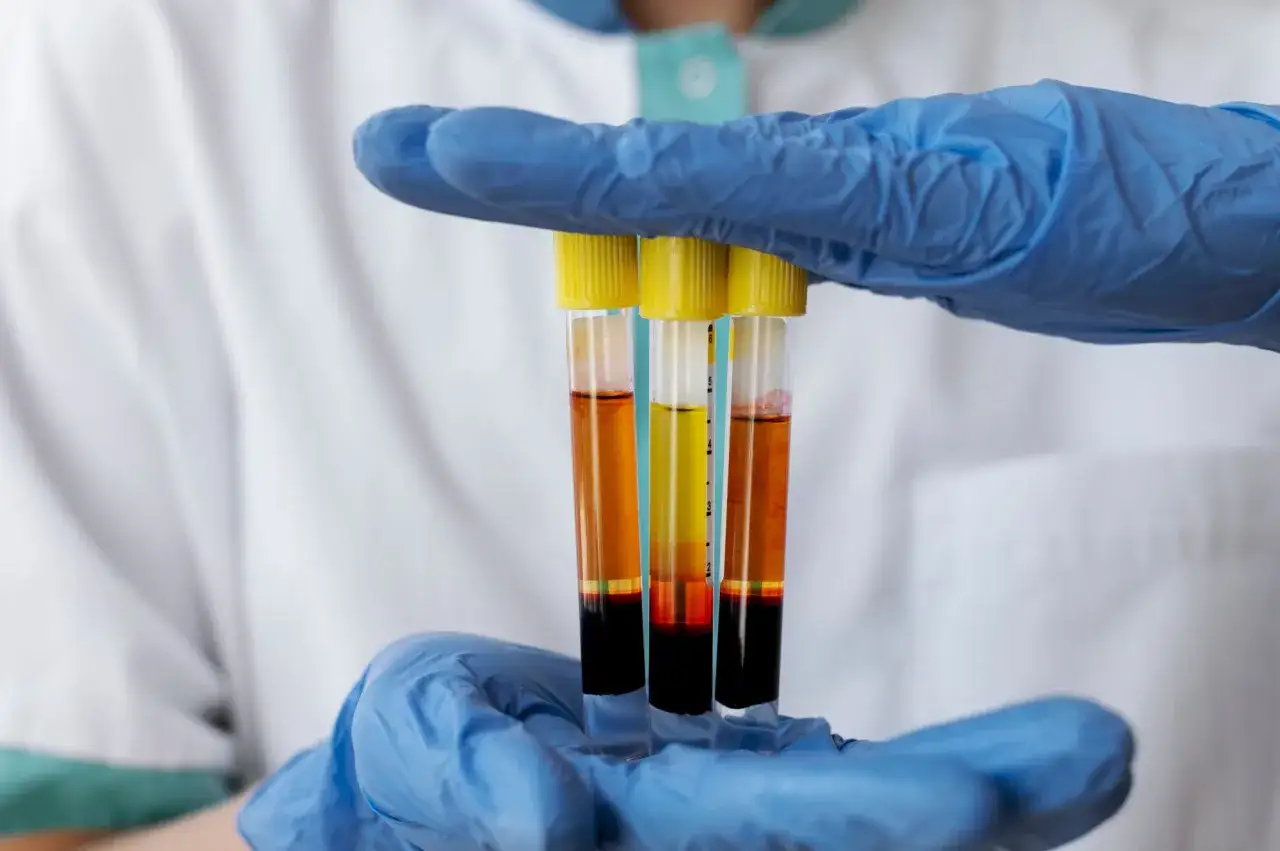 Ręce w niebieskich rękawiczkach trzymają probówki z krwią. Ciemna warstwa na dnie może wskazywać na wysoki cholesterol.