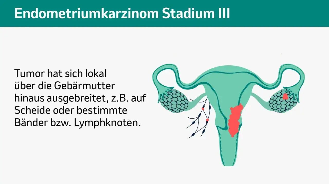 Illustration zeigt Geb&auml;rmutter mit lokal ausgebreitetem Tumor. Ein ausbleiben der Periode kann ein Symptom sein.