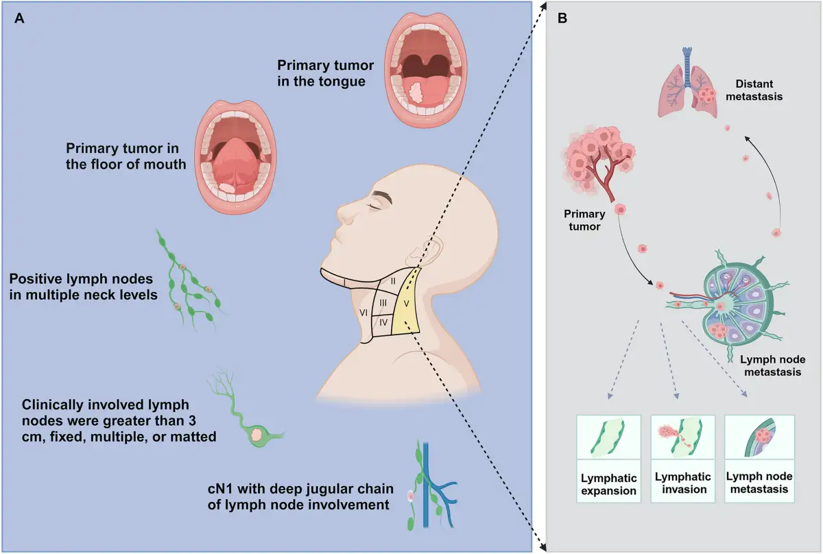 Rak jamy ustnej: rokowania zależą od lokalizacji guza (język, dno jamy ustnej) i zajęcia węzłów chłonnych szyi.