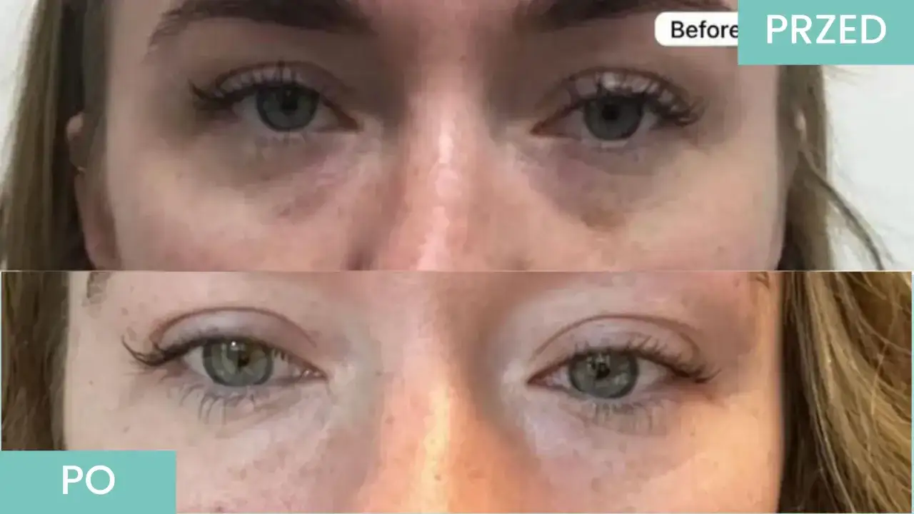 Przed i po zabiegu stymulatorami tkankowymi pod oczy. Cienie i worki pod oczami zniknęły, skóra jest wygładzona.