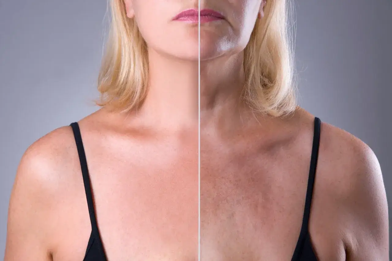 Confronto tra d&eacute;collet&eacute; prima e dopo il trattamento per le rughe. La parte sinistra mostra una pelle liscia, la destra evidenzia le rughe d&eacute;collet&eacute; come eliminarle.
