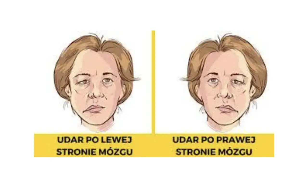 Dwie twarze z widocznym porażeniem nerwu twarzowego. Lewa strona twarzy opada po udarze mózgu po lewej stronie, prawa po udarze po prawej.