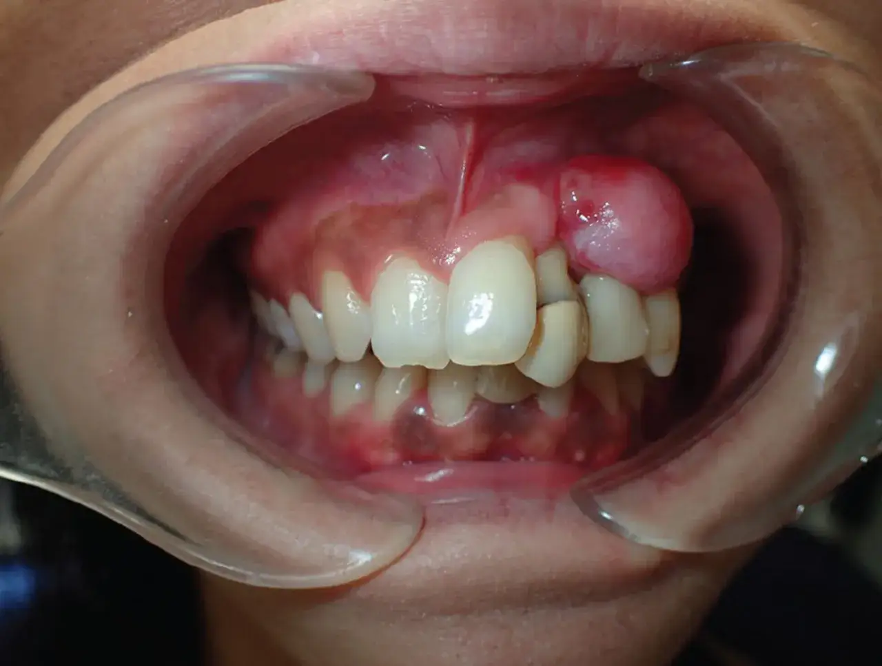 Boca abierta mostrando un epulis dental, una protuberancia rosada en la encía superior derecha, cerca de los dientes.