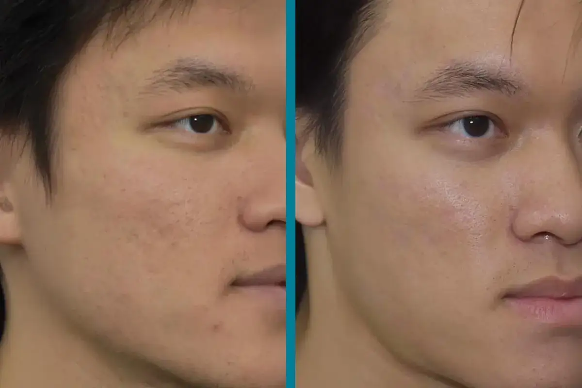 Avant/après : une peau transformée, montrant comment enlever les cicatrices d'acné pour un teint plus lisse et uniforme.