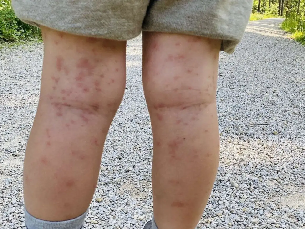 Rote, juckende Pusteln an den Beinen, ein deutlicher eichenprozessionsspinner ausschlag nach einem Spaziergang im Wald.