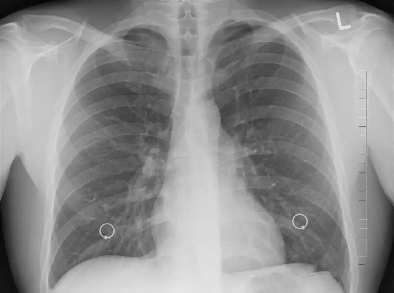 RTG klatki piersiowej z widocznymi okrągłymi markerami w płucach, potencjalnie używanymi jako pomoc w diagnostyce domowego testu na raka płuc.