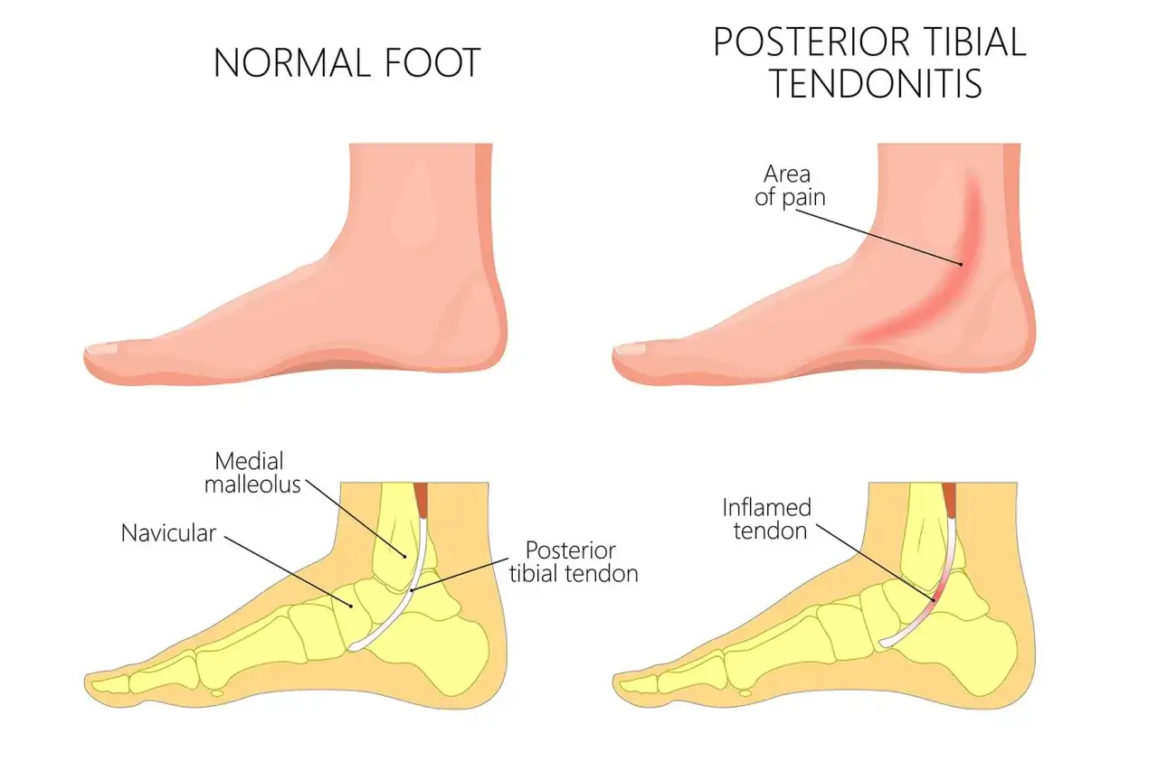 Ilustración comparativa de un pie normal y uno con tendinitis tibial posterior, mostrando el tendón inflamado y el área de dolor. Ideal para elegir calzado para tendinitis tibial posterior.