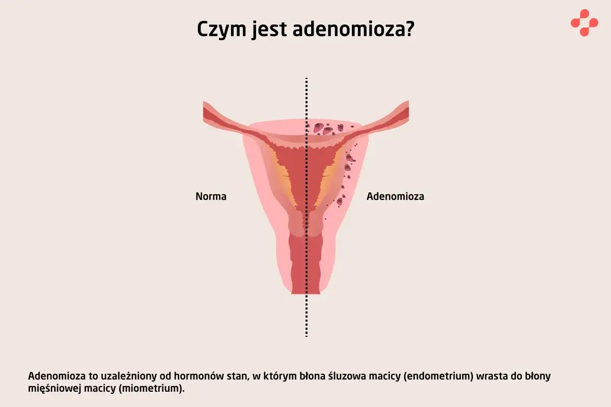 Ilustracja porównuje zdrową macicę z macicą dotkniętą **adenomiozą**, gdzie tkanka endometrium wrasta w mięśniówkę.