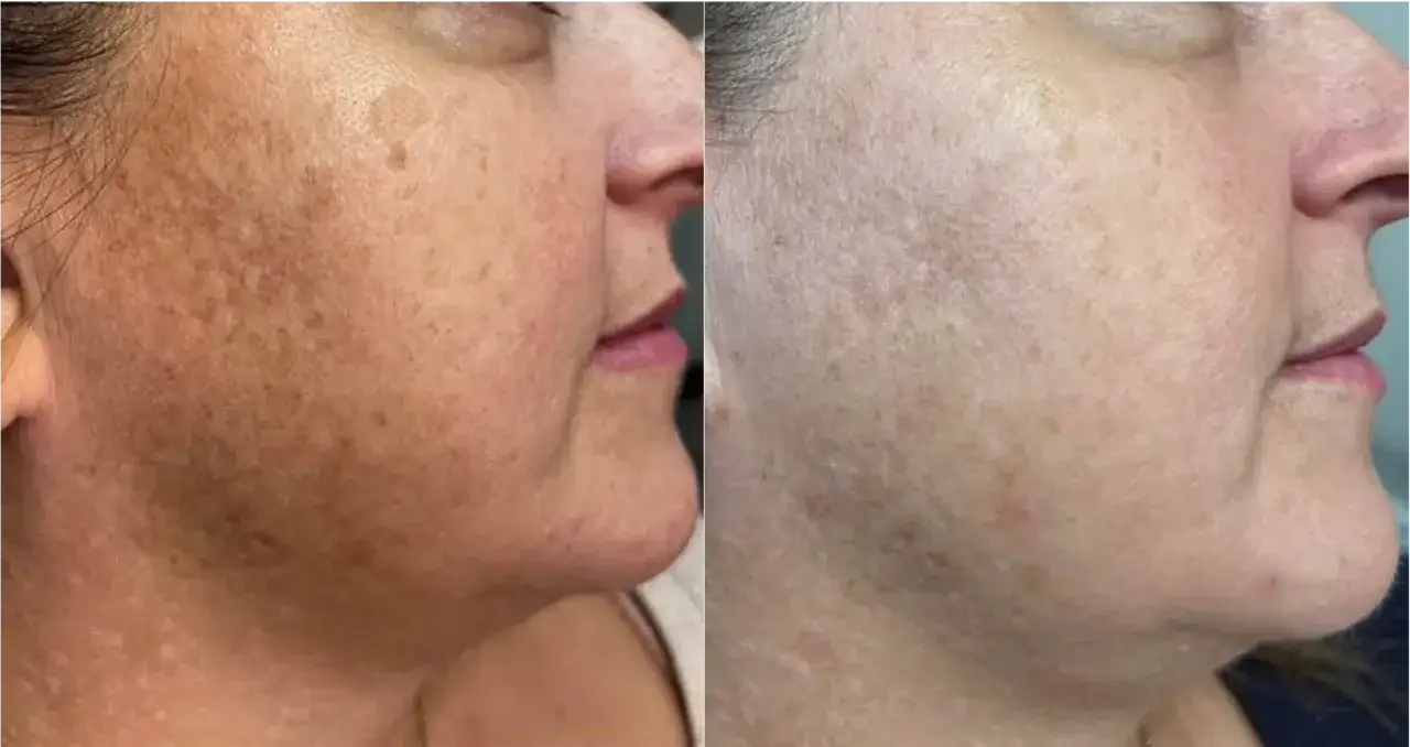 Comparaison avant/après : peau tachetée et irrégulière avant, peau plus uniforme et lumineuse après utilisation d'alpha arbutin.