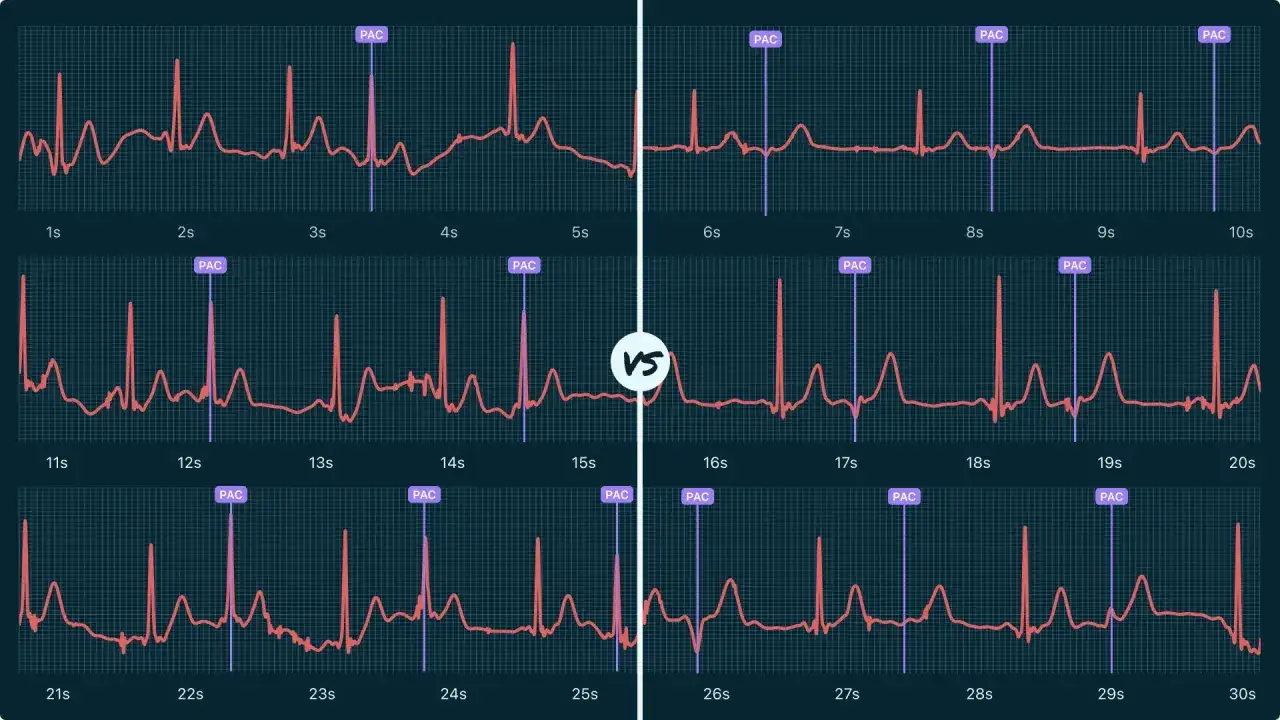 Fragmenty EKG z oznaczeniami PAC, ilustrujące bigeminia nadkomorową.