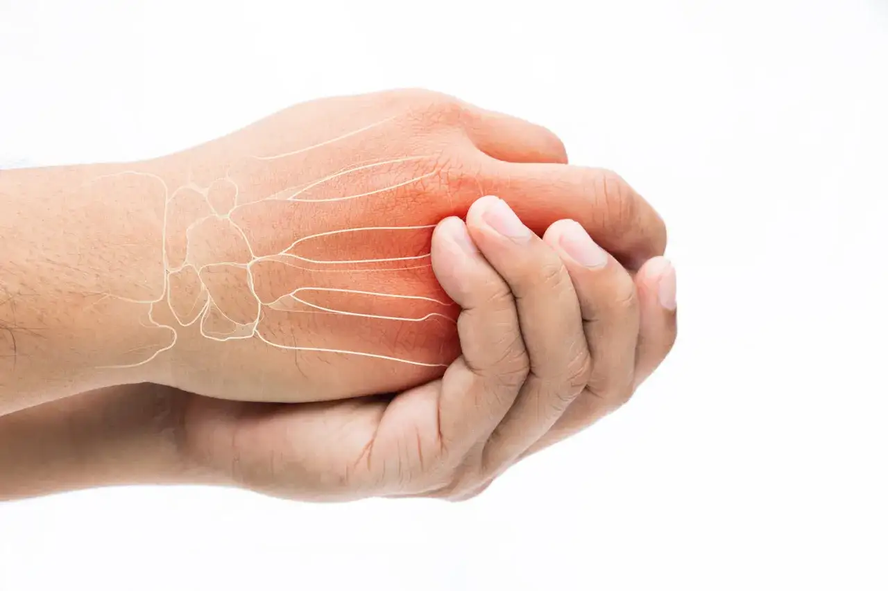 Schmerzende Hand mit Darstellung von Knochen und Nerven, die auf Arthrose im Finger hindeuten.