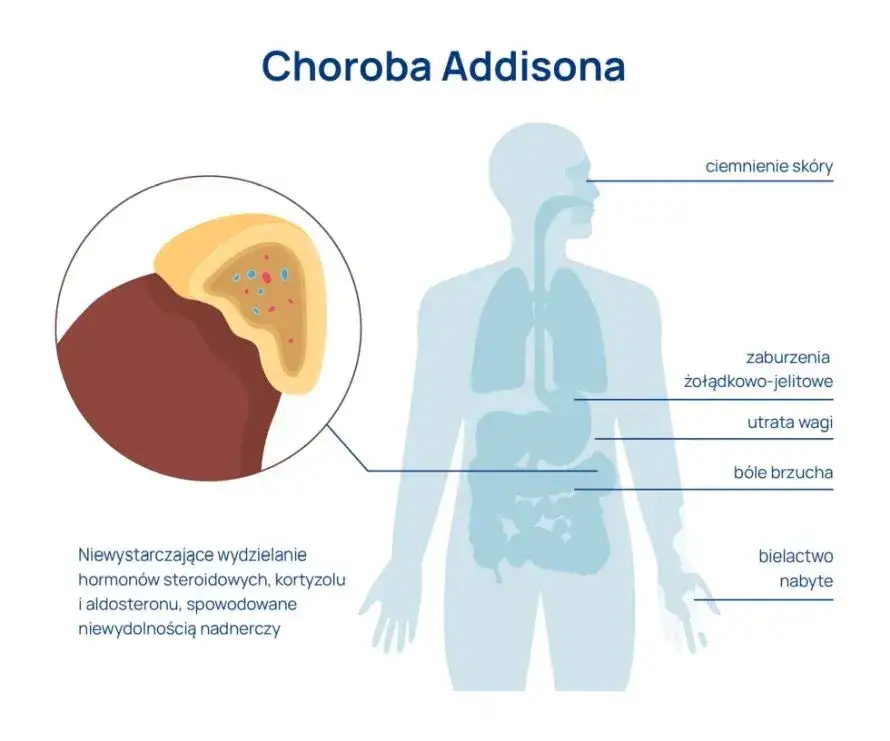 hiperpigmentacja skory choroba Addisona