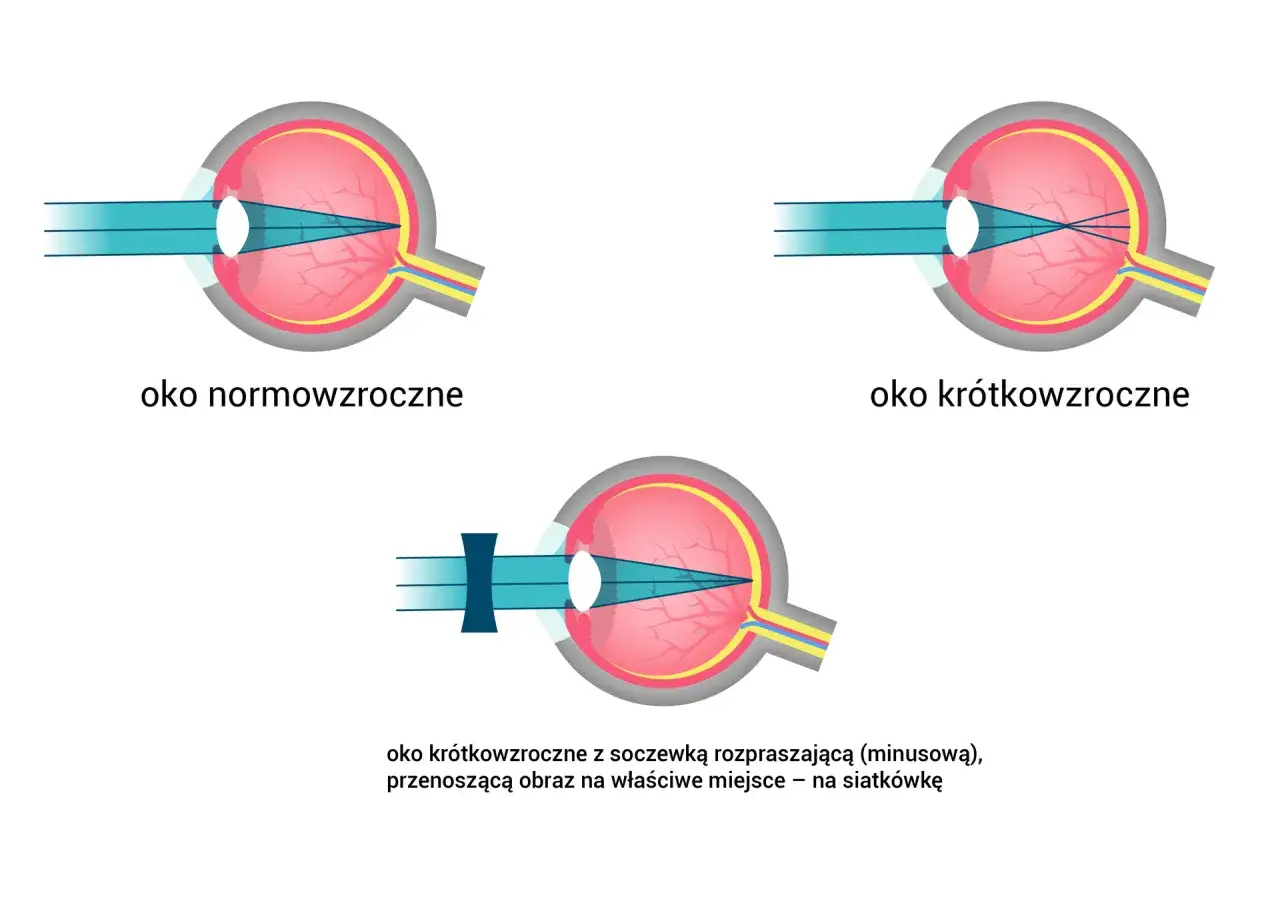 Oko normowzroczne, krótkowzroczne i krótkowzroczne z soczewką rozpraszającą. Rogówka oka skupia światło.