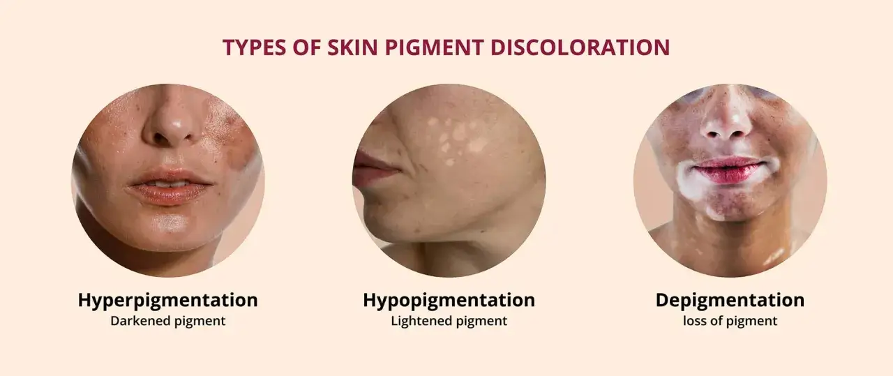 Drei Gesichter zeigen verschiedene Hautpigmentierungen: Hyperpigmentierung mit braunen Flecken, Hypopigmentierung mit hellen Flecken und Depigmentierung mit wei&szlig;en Flecken.