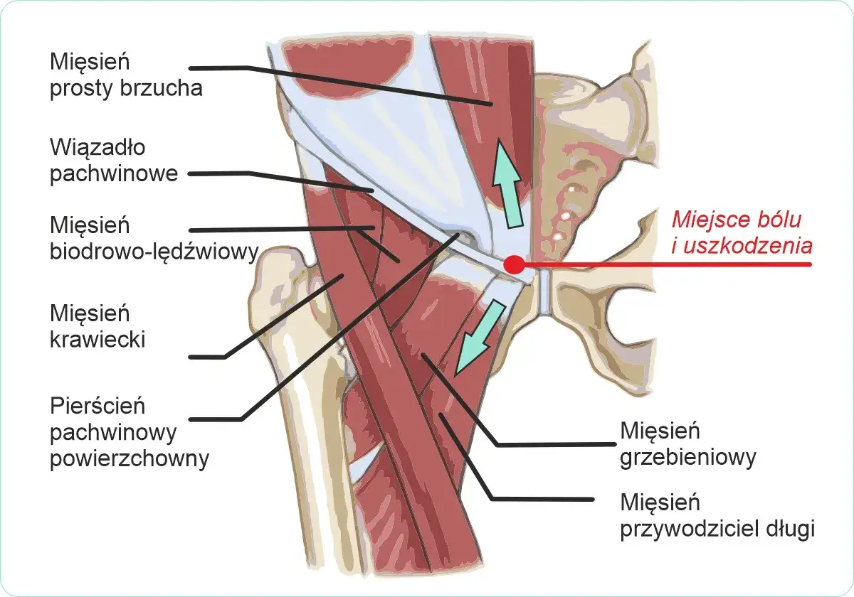 Anatomia pachwiny z zaznaczonym miejscem bólu i uszkodzenia. Może to być przyczyna zakwasów w pachwinach.
