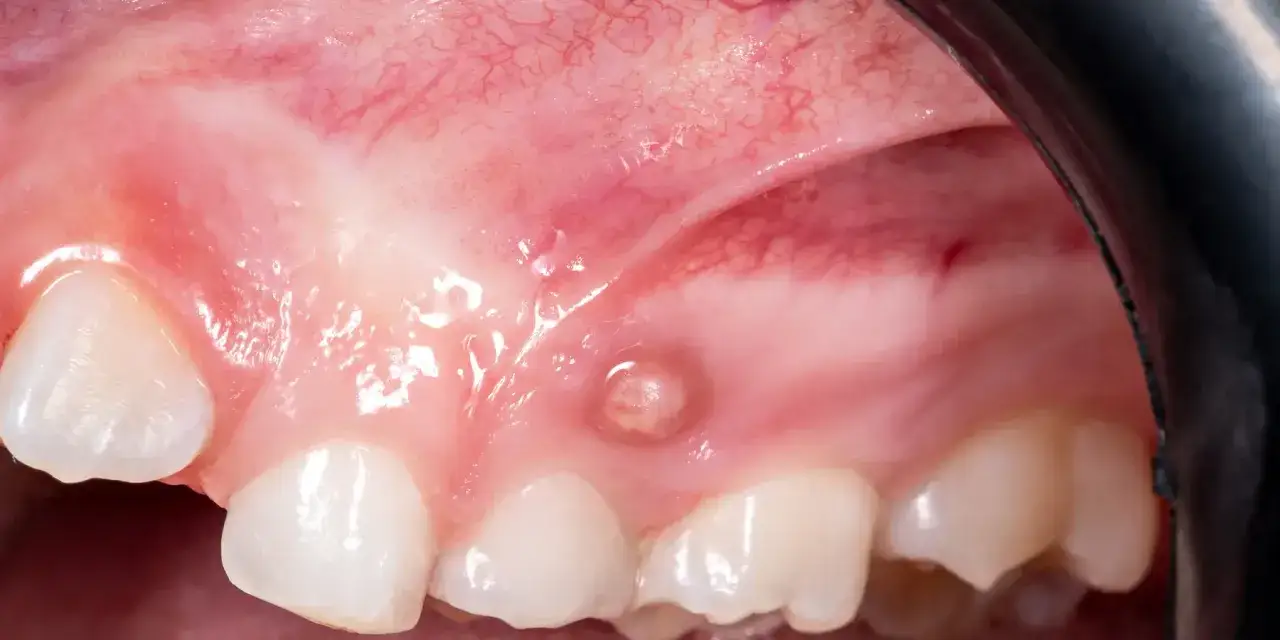Peque&ntilde;a protuberancia en la enc&iacute;a, posiblemente un quiste gingival, cerca de los dientes frontales superiores.