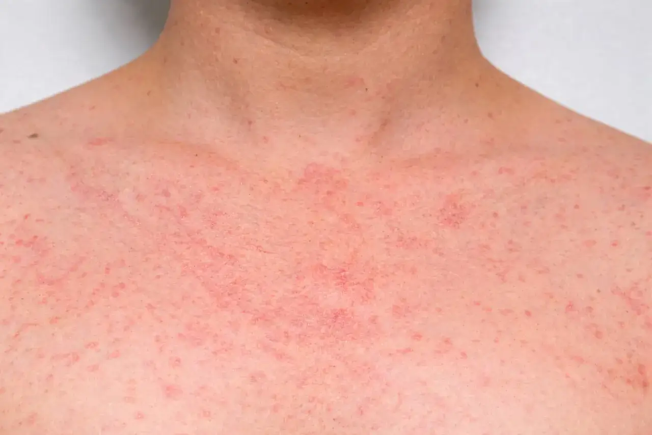 Pelle arrossata e irritata sul petto, con piccole macchie rosse. Potrebbe essere legata a sudorazione eccessiva cause.