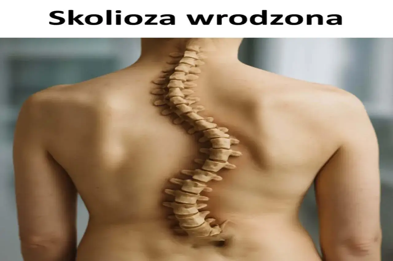 Widok z tyłu na kręgosłup z widoczną skoliozą, która wykrzywia się w kształt litery S.
