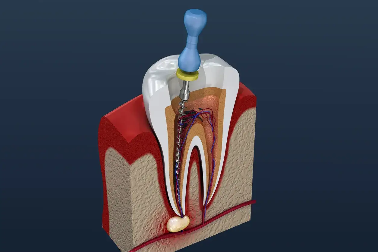 Sezione di un dente con ascesso gengivale. Strumenti dentistici inseriti nel canale radicolare.
