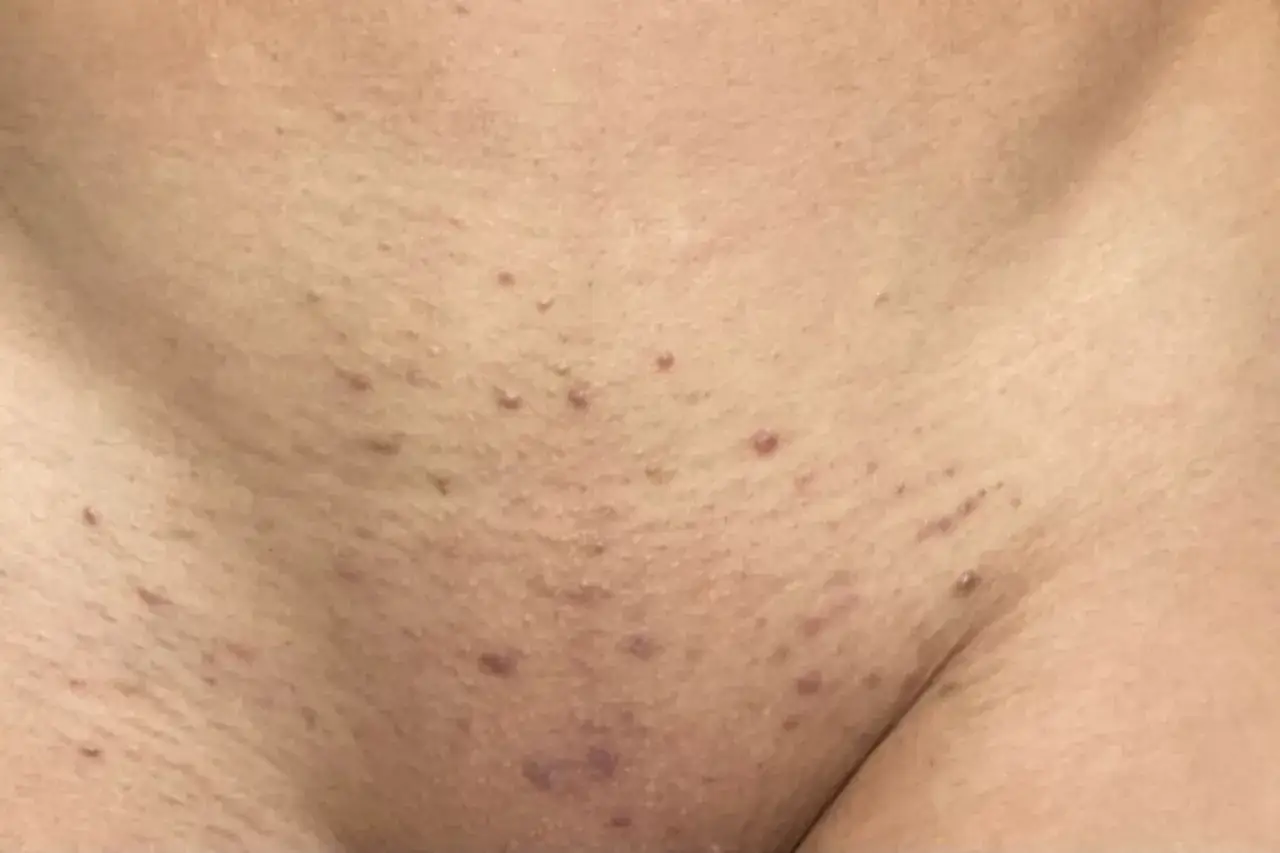 Red bumps and irritation on the skin, indicative of folliculitis and a histamine reaction after waxing.