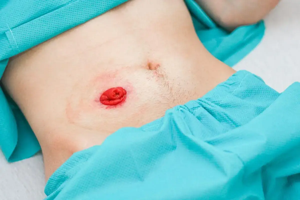 Widok brzucha z czerwoną stomią. Stoma to chirurgicznie wytworzone ujście, które pomaga w wydalaniu.