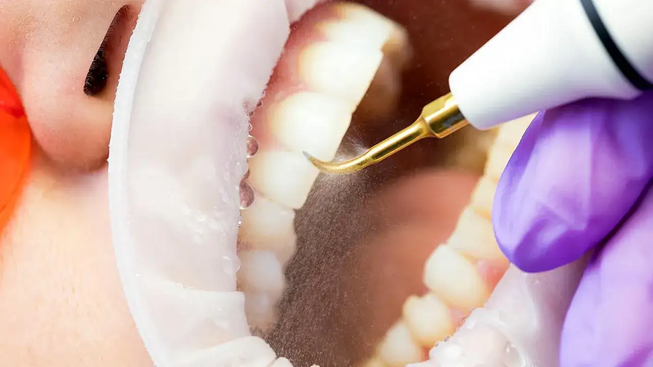 Pulizia dei denti fa male? Un dispositivo dentistico rimuove il tartaro.