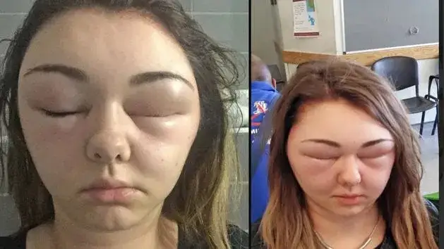 kobieta farbująca włosy w domu, zniszczone włosy po farbowaniu, reakcja alergiczna na skórze głowy
