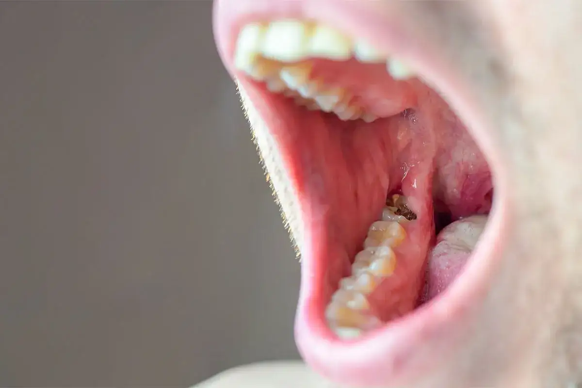 Widoczne zaawansowane stadium próchnicy na zębie, z widocznymi ubytkami i ciemnymi przebarwieniami.