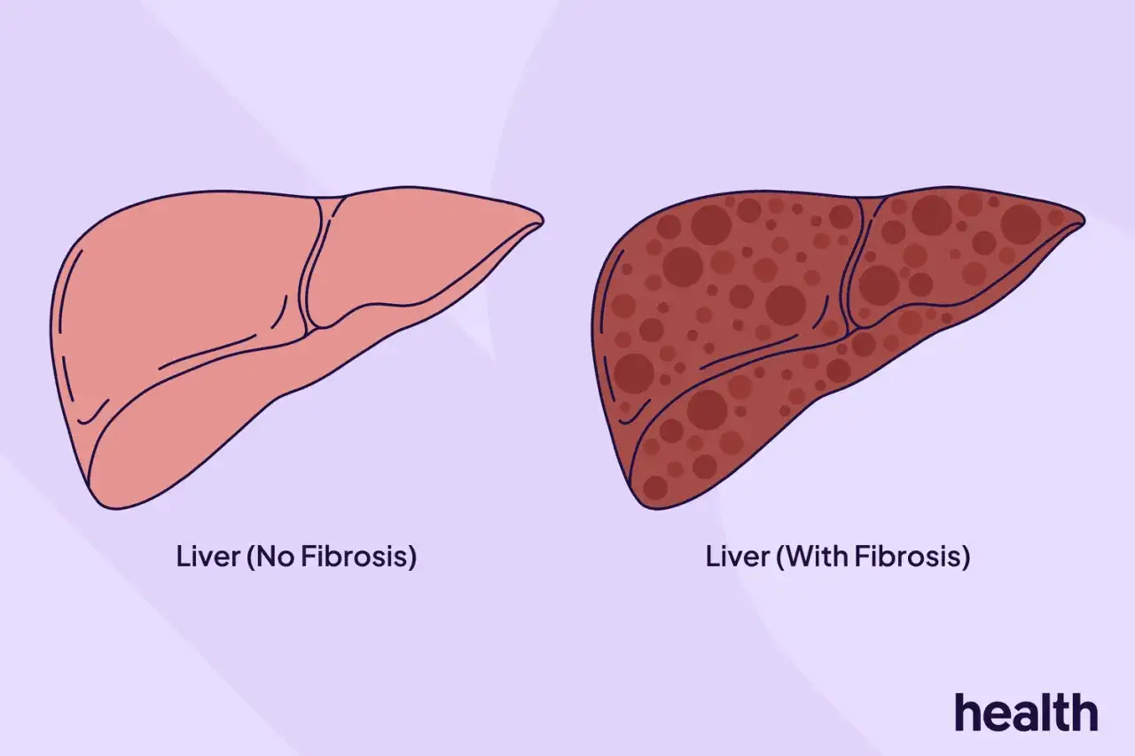 Confronto tra un fegato sano e uno con fibrosi, mostrando i danni del NASH fegato.