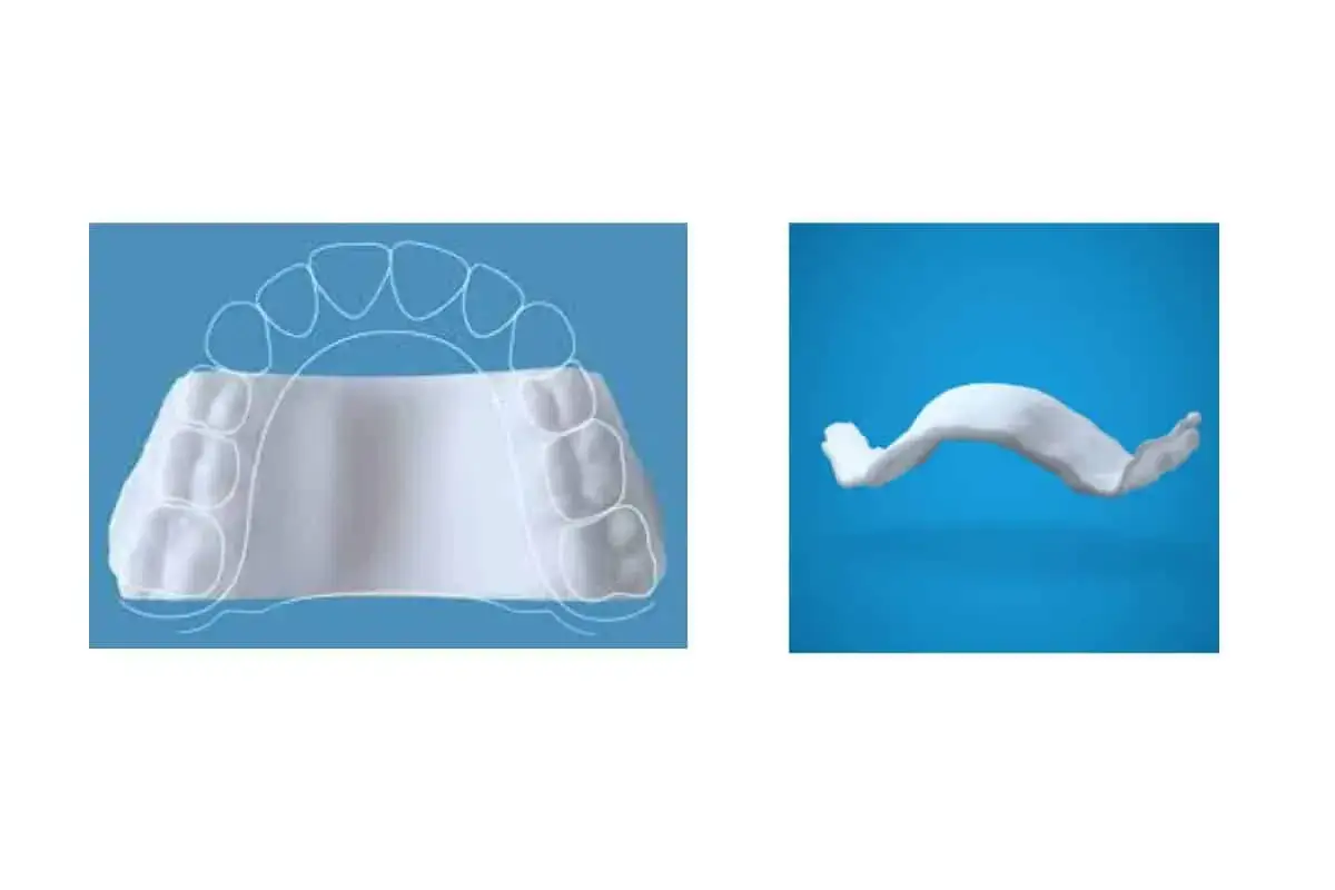 Molde dental que muestra un paladar ojival en niños. El aparato se adapta a la forma del paladar para corregir la mordida.