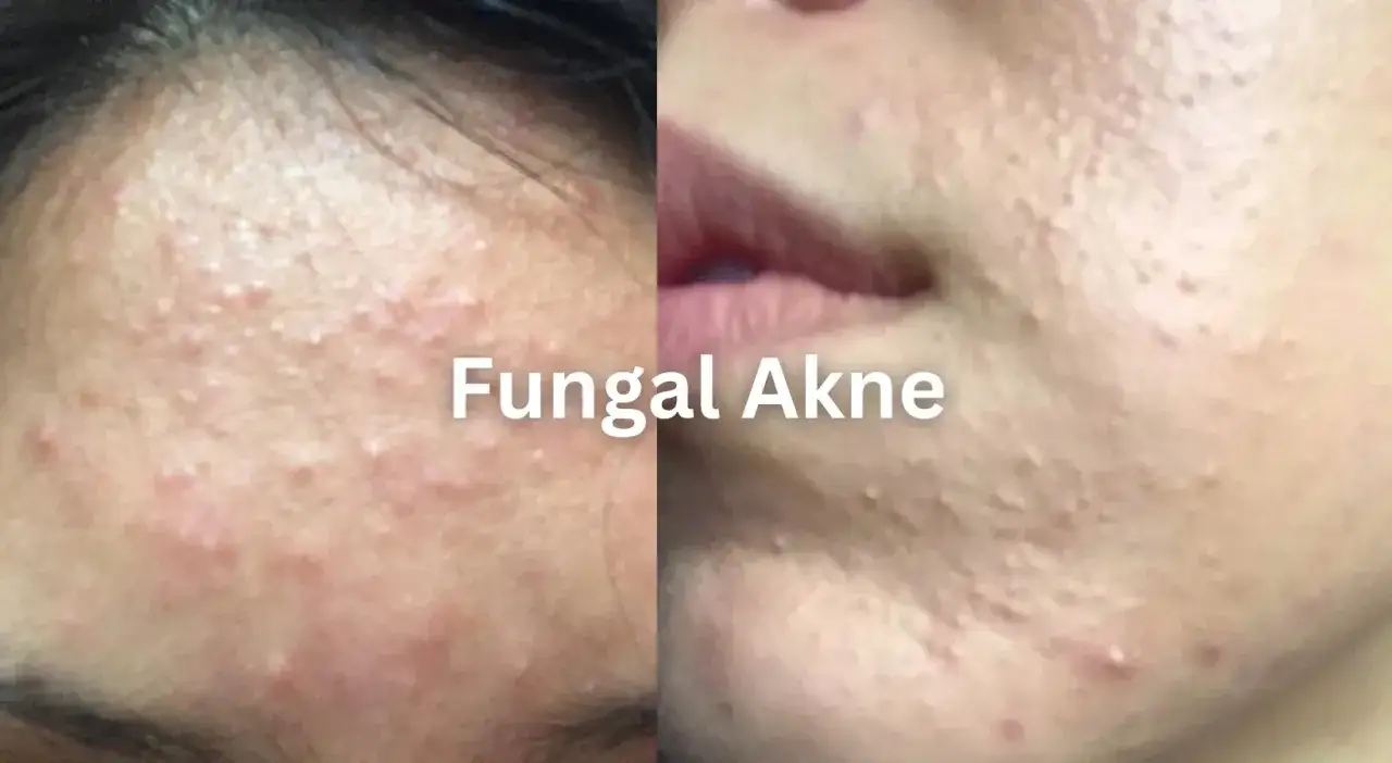 Haut mit kleinen, roten Pickelchen und Pusteln im Kinnbereich, die auf **fungal akne kinn** hindeuten.