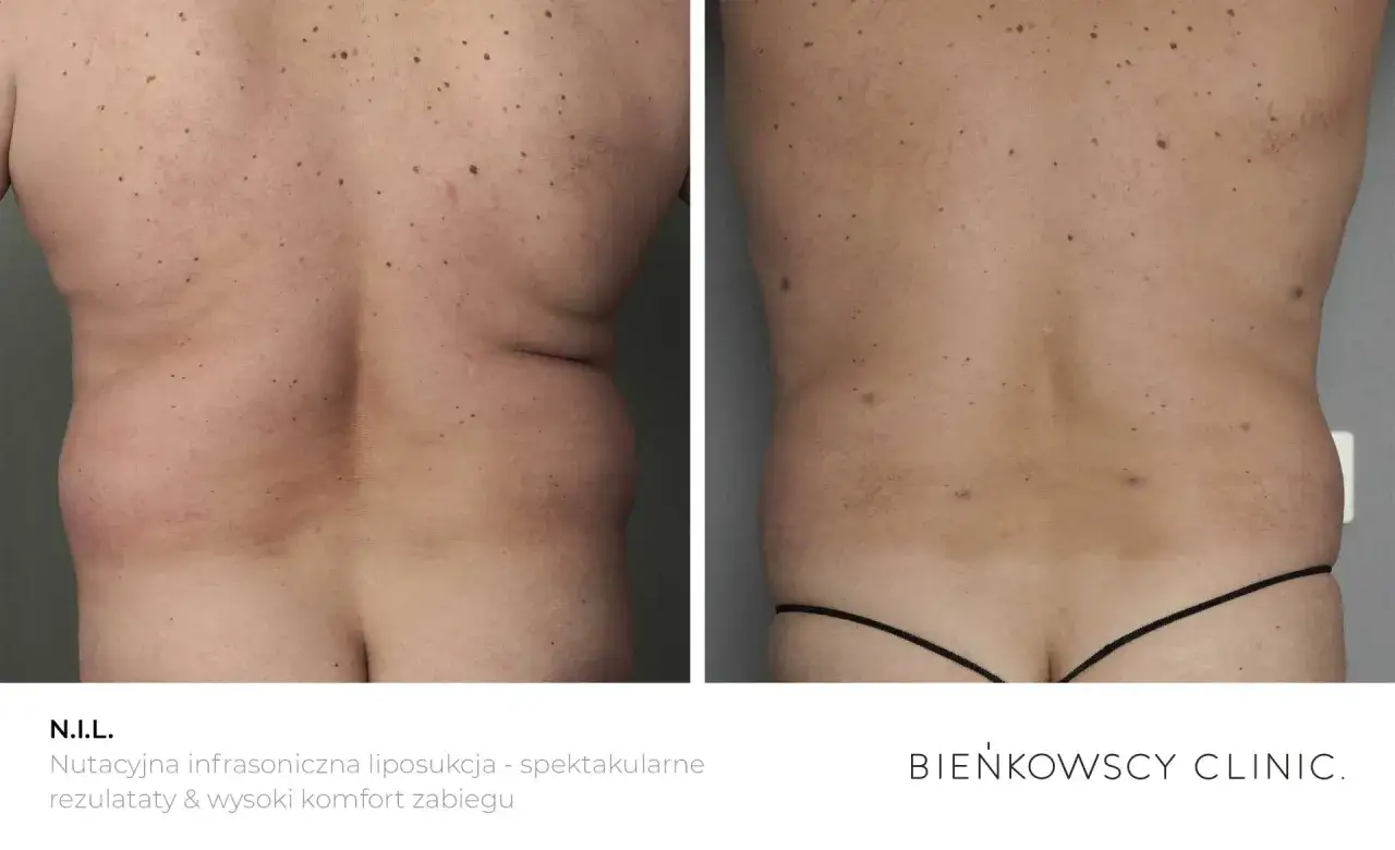 Przed i po zabiegu N.I.L. - nutacyjna liposukcja. Widoczna redukcja tkanki tłuszczowej na plecach i talii, co pokazuje, co to jest liposukcja.