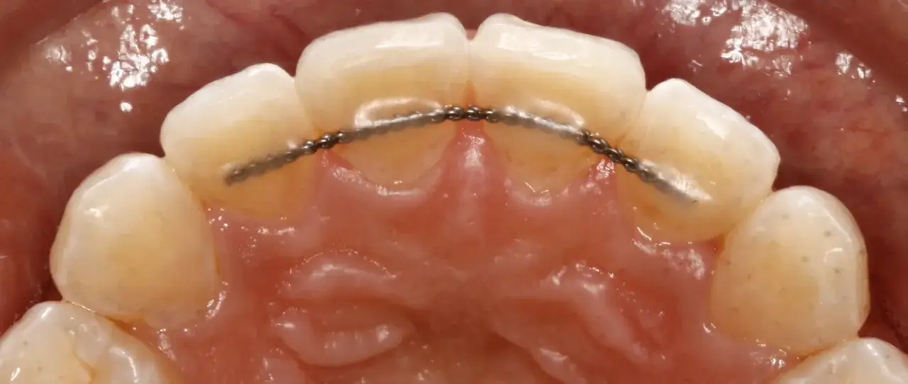 Filo metallico sottile applicato ai denti anteriori per la contenzione denti.