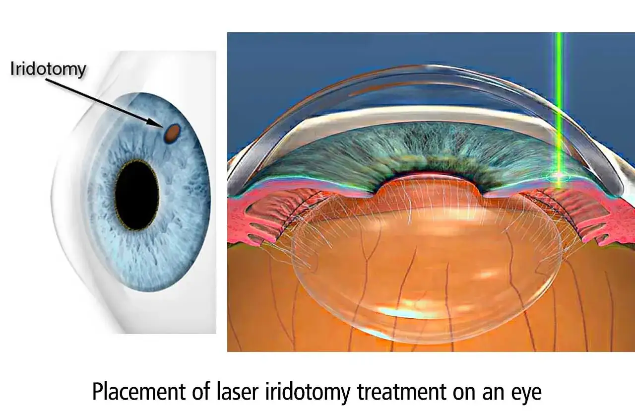 Illustrazione di iridotomia YAG laser, con un fascio verde che colpisce l'iride. Si discute dei rischi.