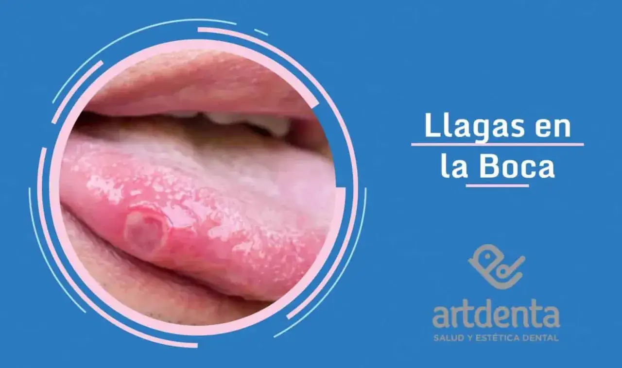 Llaga en la lengua, un síntoma común de estomatitis. Busca tratamiento dental para aliviar el dolor y curar la herida.