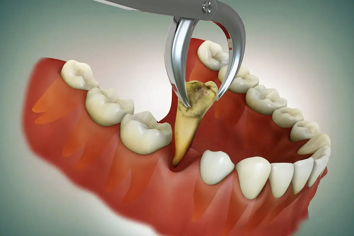 Pinzas dentales extraen una muela. &iexcl;Duele sacarse una muela!