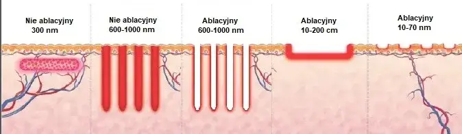 porównanie laser frakcyjny ablacyjny nieablacyjny
