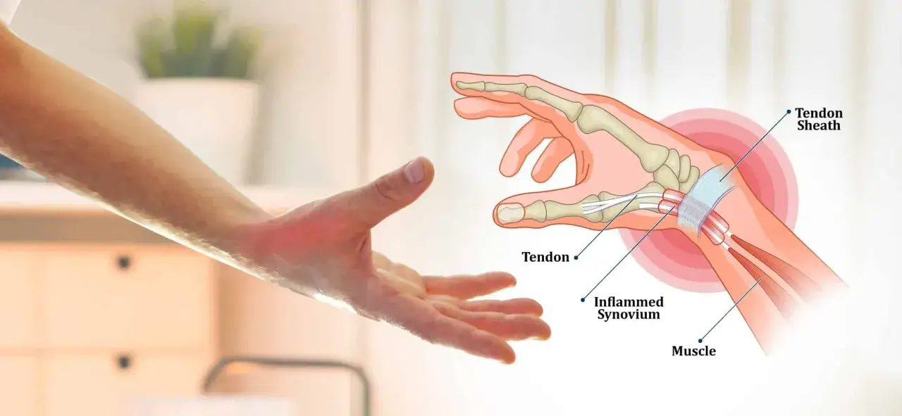 Anatomia dłoni z zaznaczonym zapaleniem pochewki ścięgna, objawem choroby de Quervaina.