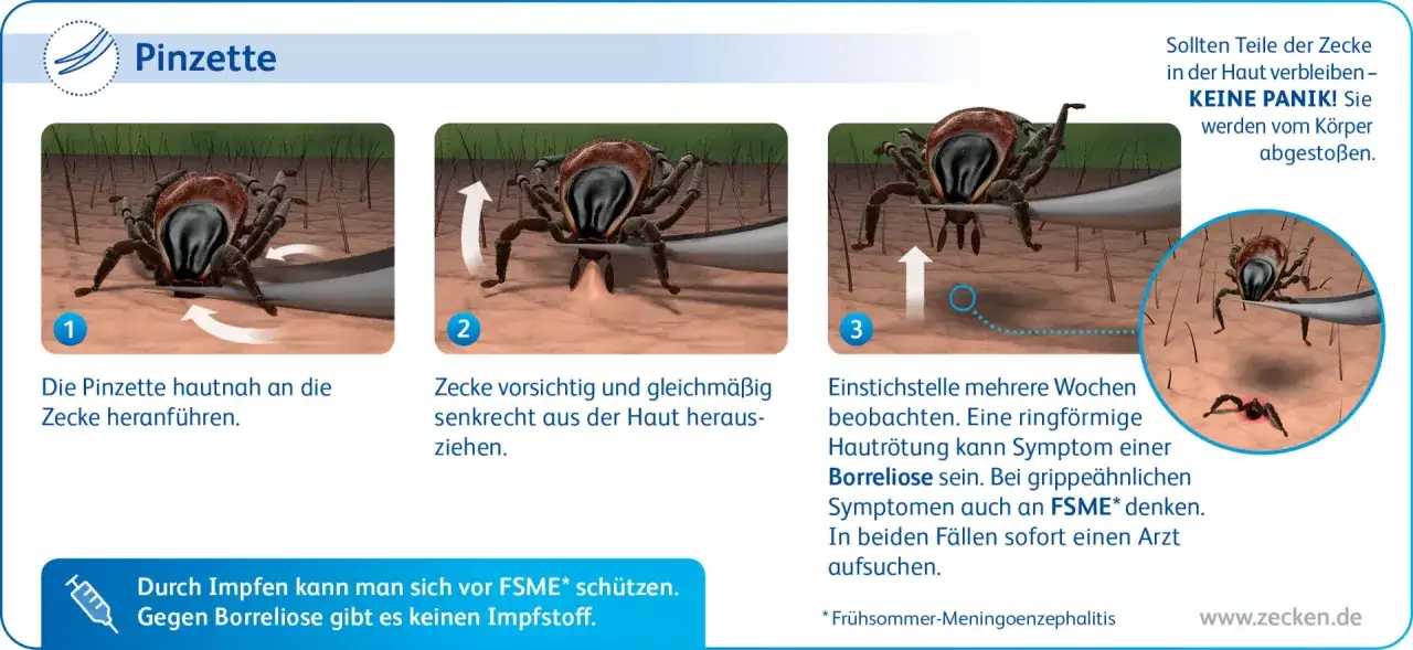 Schritt-f&uuml;r-Schritt-Anleitung zur Zeckenentfernung mit einer Pinzette. So entfernst du eine Zecke richtig.